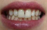 Izbjeljivanje zuba-poslije 2